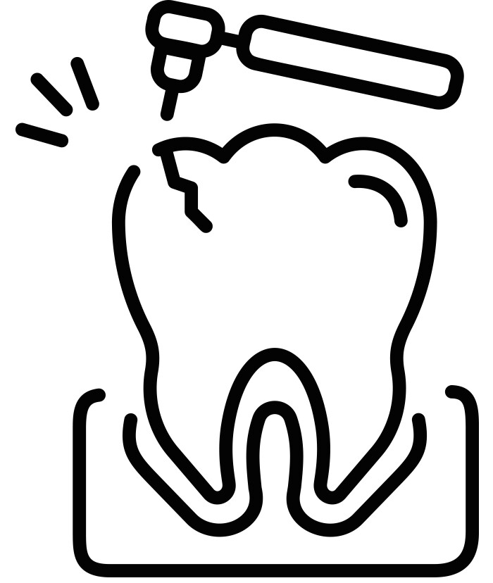 Composite Fillings