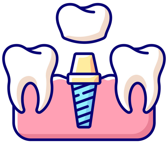 Dental Implants
