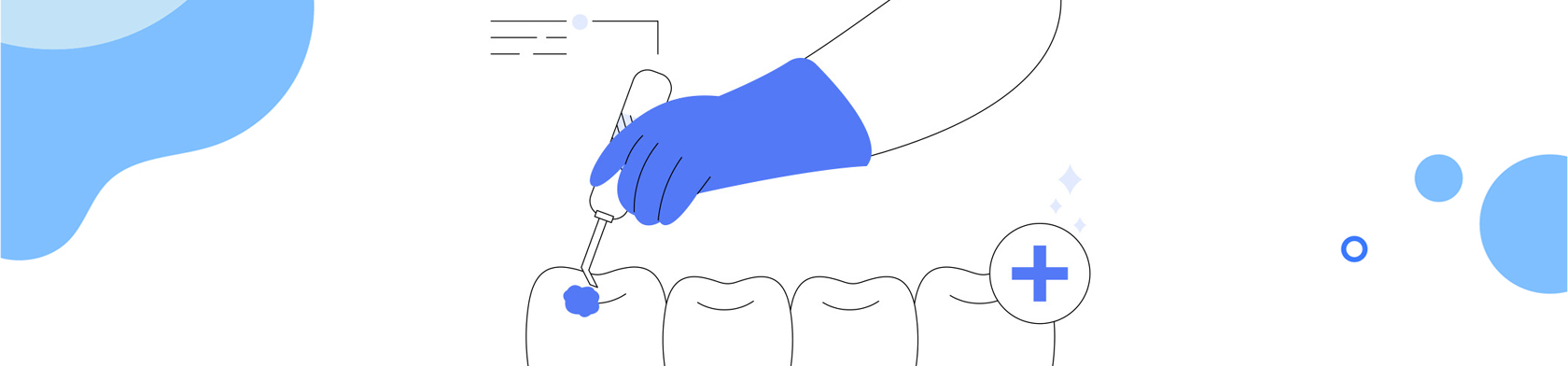 Composite Fillings