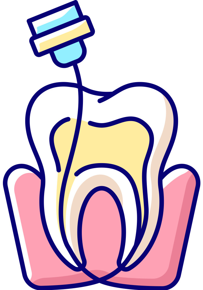 Root Canal